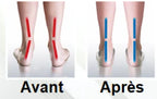 Semelles Orthopédiques Pour Pieds Plats